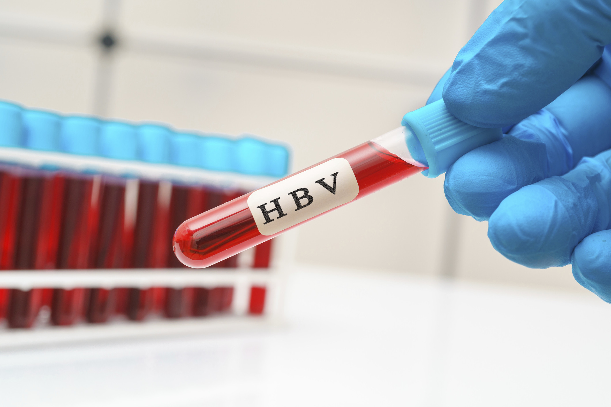 HBV DNA Kuantitatif